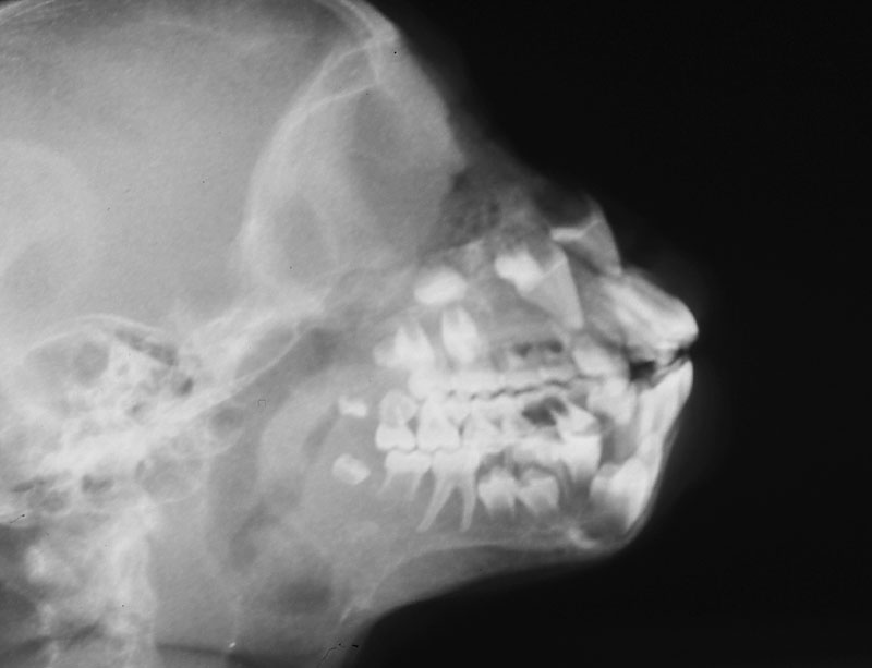 サルの乳歯遺残
